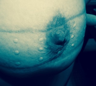 Belt marks across nipple