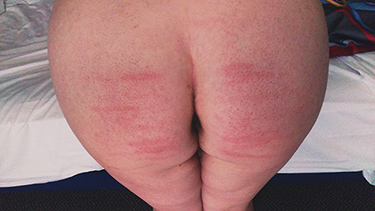Woman with welt marks from cane on her bottom