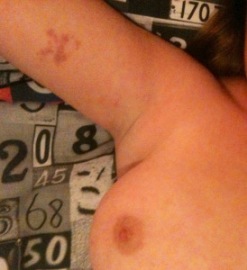 Bruise on arm with breast showing BDSM