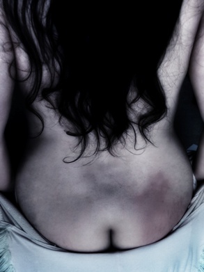 Long dark hair down womans back with red bruise showing on her bottom